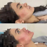 تزریق فیلر،ژل،بوتاکس|خدمات آرایشگری و زیبایی|کرمانشاه, |دیوار