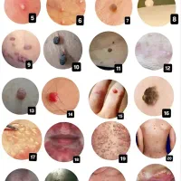 زگیل و تبخال hpv/hsv|آرایشی، بهداشتی، درمانی|اهواز, دانشگاه چمران|دیوار