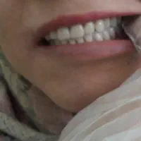 دندان مصنوعی متحرک (تحویل ۳ روزه)|خدمات آرایشگری و زیبایی|کرمانشاه, |دیوار