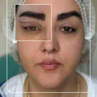 تزریق چربی بوکال فت کاشت مو ساکشن غبغب بلفاروپلاسی|خدمات آرایشگری و زیبایی|اصفهان, ملک‌شهر|دیوار
