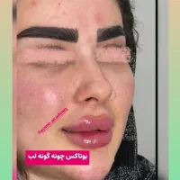 جشنواره فیلر و بوتاکس با بهترین متریال|خدمات آرایشگری و زیبایی|یزد, |دیوار