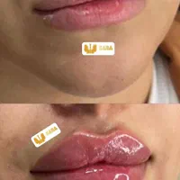 تزریق ژل و بوتاکس|خدمات آرایشگری و زیبایی|اهواز, نادری|دیوار