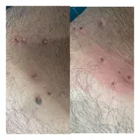 برداشتن خال زگیل میخچه باقیمت فوق العاده توسط پزشک|خدمات آرایشگری و زیبایی|اسلام‌شهر, |دیوار