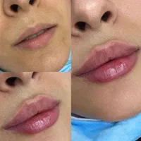 لیزر‌موزائد،ژل بوتاکس مزو،ریمو تتو،هایفو فیشال|خدمات آرایشگری و زیبایی|تهران, جیحون|دیوار