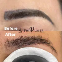 لیزر پاک کردن انواع تتو