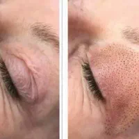 رفع چروک پیشانی چشم خط خنده جای جوش خالبرداری لیزر