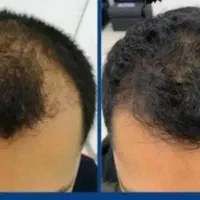 رفع انواع ریزش و کم پشتی مو|آرایشی، بهداشتی، درمانی|تهران, نصرت|دیوار
