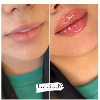 جشنواره ویژه ژل لب فیلر990بوتاکس850 پزشک متخصص