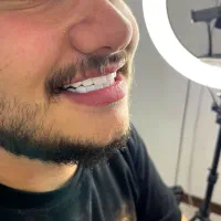 جشنواره تخفیفات کامپوزیت دندان