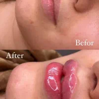 تزریق ژل و بوتاکس در کلینیک زیبایی|خدمات آرایشگری و زیبایی|کرمانشاه, |دیوار