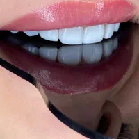 دندانپزشکی کامپوزیت ایمپلنت عصب کشی پر کردن|خدمات آرایشگری و زیبایی|قدس, |دیوار
