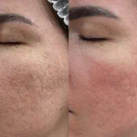 پاکسازی و فیشال /درمان جوش و لک و منافذباز|خدمات آرایشگری و زیبایی|کرمانشاه, |دیوار