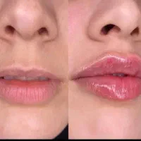 تزریق فیلر|خدمات آرایشگری و زیبایی|الشتر, |دیوار