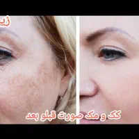 حذف تتو پاک کردن تتو بالیزر/رفع تیرگی/رفع کک و مک|خدمات آرایشگری و زیبایی|مشهد, هنرستان|دیوار