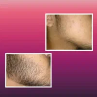 رویش ریش و سبیل و مو