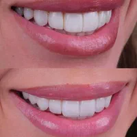 ایمپلنت باضمانت/سویسی/کره ای