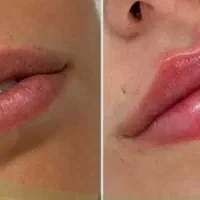 ژل بوتاکس|خدمات آرایشگری و زیبایی|جیرفت, |دیوار