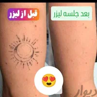 کلینیک تخصصی پاک کردن تتو با لیزر تضمینی/ریمو ابرو|خدمات آرایشگری و زیبایی|مشهد, کوثر|دیوار