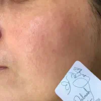 برداشتن لک و کک و مک|خدمات آرایشگری و زیبایی|نورآباد, |دیوار