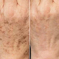 لیزر موهای زائدروشن کننده ورفع لک رفع منافذبوتاکس|خدمات آرایشگری و زیبایی|رشت, بوسار|دیوار