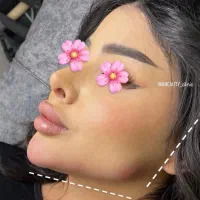 تزریق ژل و بوتاکس در منزل