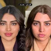 تزریق ژل و بوتاکس مزو ژل