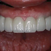 دندانپزشکی،ایمپلنت و اوردنچر با اقساط دو ساله