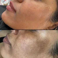 آموزش و خدمات تکنیک پوست مار و مزونیدلینگ|خدمات آرایشگری و زیبایی|اسلام‌شهر, باغ فیض|دیوار