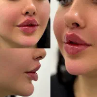 تزریق ژل لب کرج جشنواره عیدانه تزریق فیلر بوتاکس