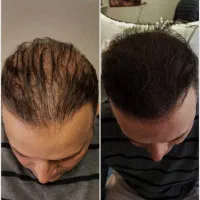 ریزش مو داری، نانوپلاس رو بشناس