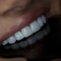 جشنواره کامپوزیت لمینیت روکش عصب ترمیم IMAX IPS|خدمات آرایشگری و زیبایی|تهران, هفت حوض|دیوار