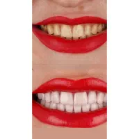 عصب‌کشی،کامپوزیت ونیر،روکش تعرفه پایین دندانپزشک