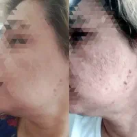 کربوکسی تراپی تزریقی