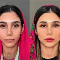 بوتاکس چشم گربه ایی‌/مادلینگ فول فیس