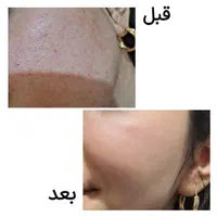 کرم معجزه صد در صد تضمینی با 10سال سابقه کار|آرایشی، بهداشتی، درمانی|خرمشهر, |دیوار