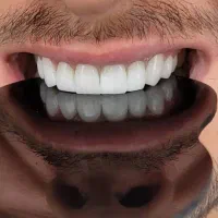 کامپوزیت/لمینیت/عصب کشی/روکش طلا|خدمات آرایشگری و زیبایی|تهران, دردشت|دیوار