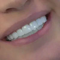 (طرح لبخند)،کامپوزیت زیبایی دندان