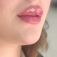 تزریق فیلر بادی بدن۱۲۰هزار