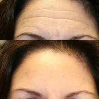 جشنواره تخفیف پی آر پی و ژل و بوتاکس|خدمات آرایشگری و زیبایی|شیراز, زرگری|دیوار