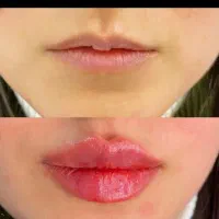 ، تزریق ژل فیلر بوتاکس مزو فیلر بادی..|خدمات آرایشگری و زیبایی|شیراز, فضل‌آباد|دیوار