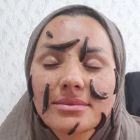 زالو درمانی در مطب طب اسلامی و سنتی