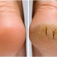 کفسابی پا، رفع ترک پا،پدیکور تخصصی
