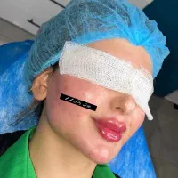 لیپوماتیک فقط۲۲تومن ژل صورت تزریق چربی