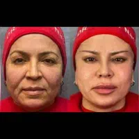 تزریق ژل فیلر مزوژل جوانساز بوتاکس لب روسی مزو مو|خدمات آرایشگری و زیبایی|کرج, گلشهر|دیوار
