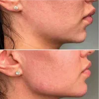 تزریق ژل بوتاکس لیفت مادلینگ و کانتورینگ کلینیک|خدمات آرایشگری و زیبایی|بندرعباس, |دیوار