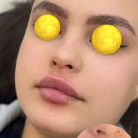 ژل و بوتاکس