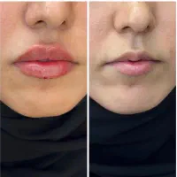 فرصت استثنایی جهت تزریقات زیبایی صورت