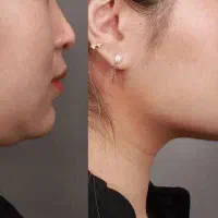 تزریق چربی و فیلربیکینی بانوان و آقایان/ساکشن چربی