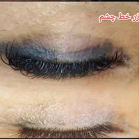حذف تتو پاک کردن تتو بالیزر/رفع تیرگی/رفع کک و مک|خدمات آرایشگری و زیبایی|مشهد, هنرستان|دیوار