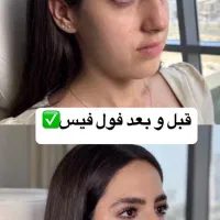 تخفیفات طلایی/ژل لب/ بوتاکس/ گونه/ فول فیس خط خنده|خدمات آرایشگری و زیبایی|مشهد, دانشجو|دیوار